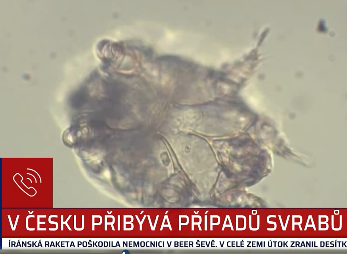Kateřina Fabiánová pro Primu: Neléčený svrab může vést až k závažné bakteriální infekci