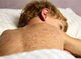 Spalničky v Evropě přibývají. V České republice je situace zatím pod kontrolou, klíčová je prevence