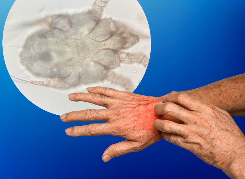 Svrab – aktuální epidemiologická situace 2026